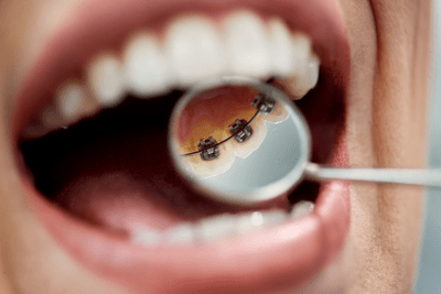Lingual Braces (400 × 267px)